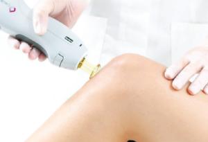 LaBrise_hair_removal